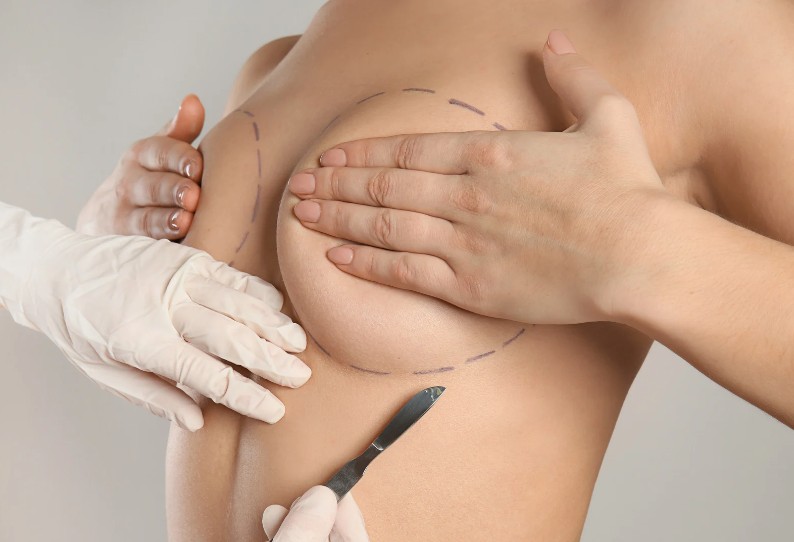 隆乳手術打造理想的豐滿胸型